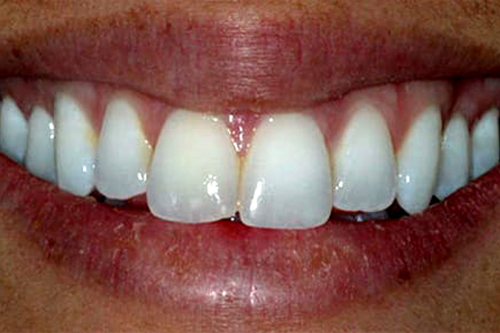 before and after treatment at Atlanta Dental Spa