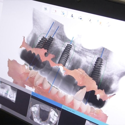 All-on-X 3-D Surgical design model