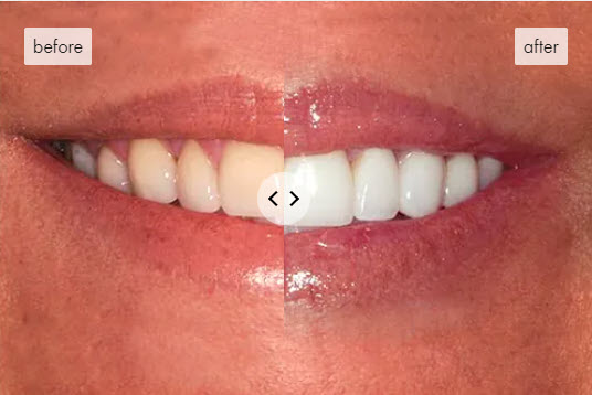Atlanta Dental Spa No Prep Veneers Before & After