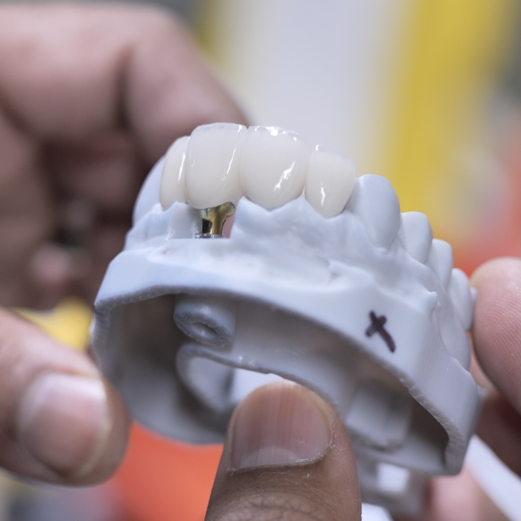 A custom-made dental appliance from the Atlanta Dental Spa lab, showcasing the skill of our ceramists.