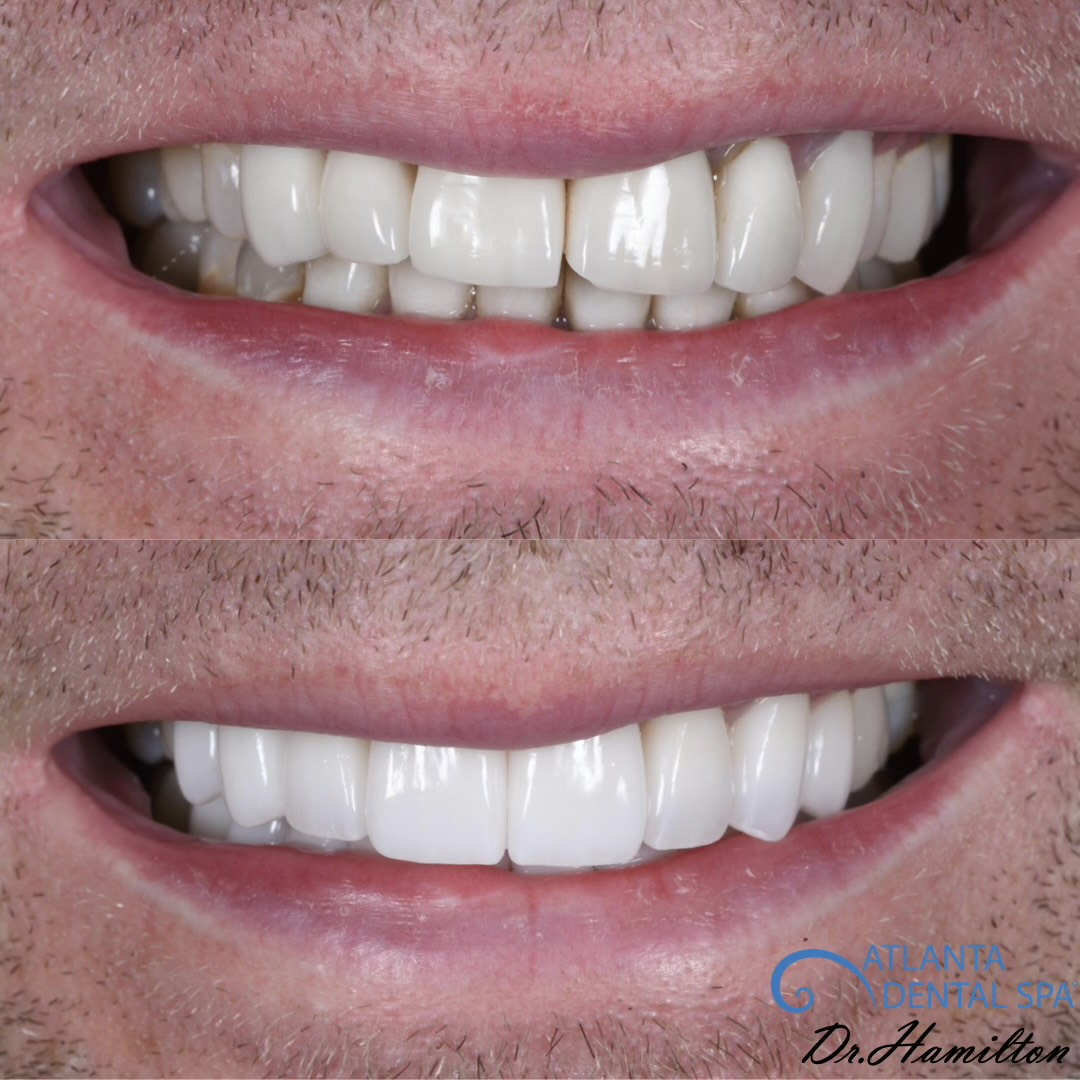 A before and after of a veneers patient from Dr. Hamilton that was done under IV Sedation.