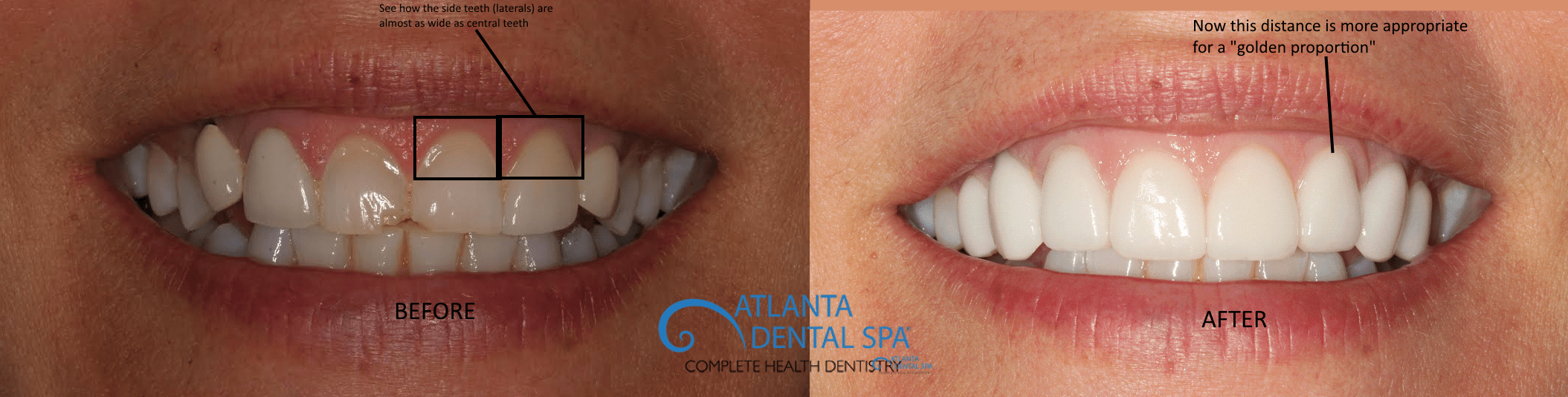 Before And After Smiles From Top Cosmetic Dentist In Atlanta, GA